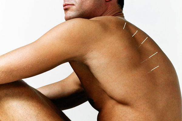 medicinska akupunktura