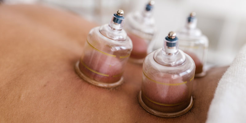 cupping